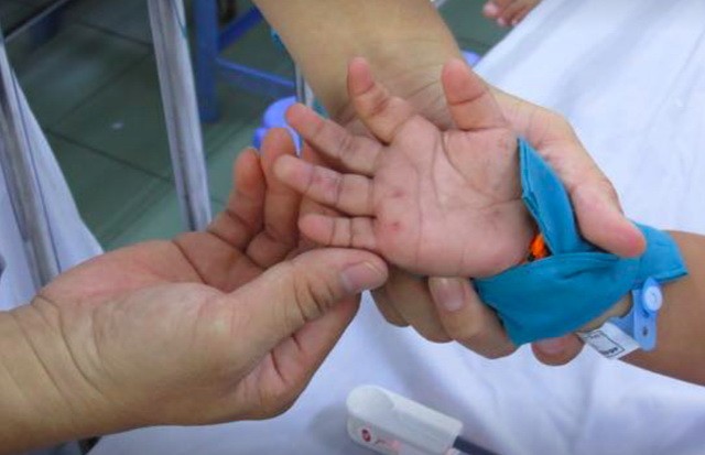 市衛生防疫中心：登革熱、手足口、麻疹傳染病例的新增病例呈下降趨勢。（示意圖源：互聯網）