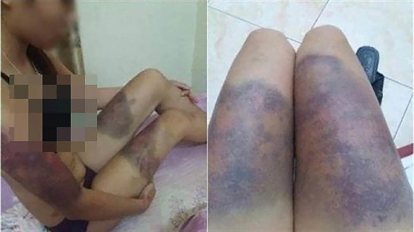 遭非法扣押毆打的孕婦阿Y遍體鱗傷。（圖源：Vietnamnet）