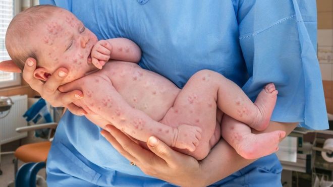 世界衛生組織的數據顯示，2019年第一季度，已上報麻疹病例與2018年同期相比增長了300%。世衛組織將人們對疫苗的錯誤理解、謠言和猶豫不決的態度。（圖源：Getty Images）