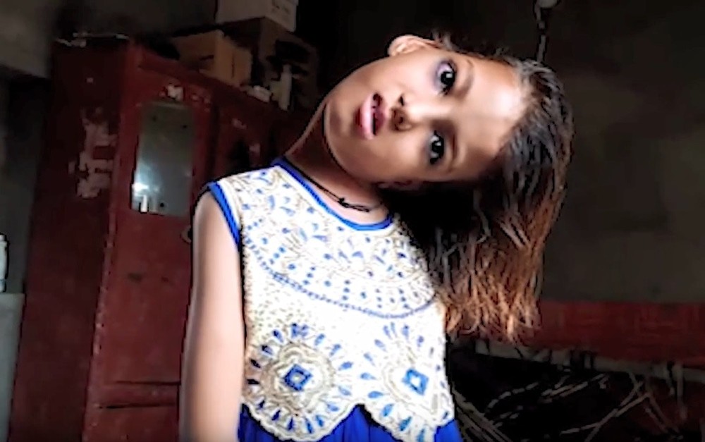 巴基斯坦一名11歲的女童，整個頸部呈現90度扭曲。(圖源：翻攝自YouTube)  