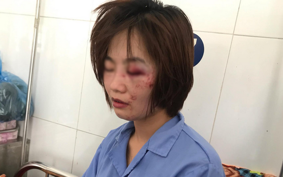 遭一夥青年毆打滿臉傷勢的巴士女乘務員Đ.T.H。（圖源：嘉團）