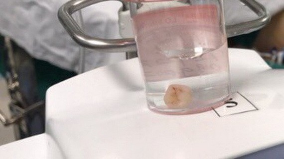 醫生採用內窺鏡技術從病童肺部取出的異物牙齒一顆。（圖源：院方提供）