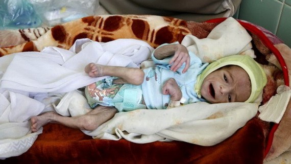 這張照片拍攝於也門首都薩那一家名為 Al-Sabaeen的醫院，很多營養不良的兒童正在這家醫院接受救治，醫生們正竭盡全力挽救這些無辜的可憐小生命。（圖源：互聯網）