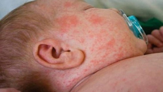 南太平洋島國薩摩亞政府22日證實，該國自10月中旬出現麻疹疫情以來，已報告麻疹病例1644例，致死20人。（示意圖源：互聯網）