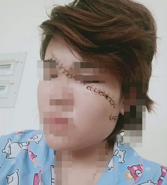 受害者的臉部遭歹徒劃傷，要送醫縫25針。（圖源：受害者提供）
