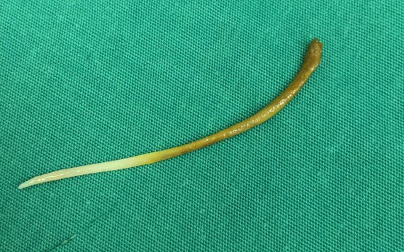 經軟管內窺鏡手術從患者的消化道取出一根長約5釐米的魚刺。（）