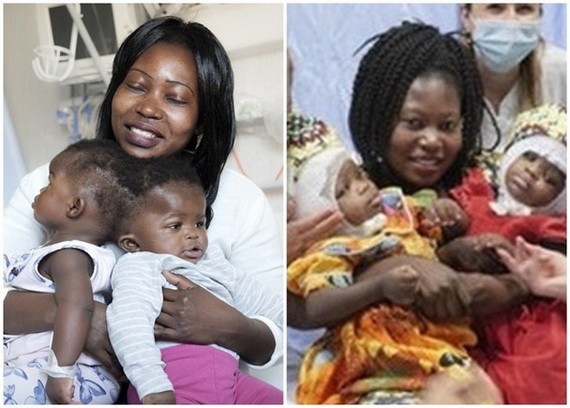 女嬰分割前後對比照，左為手術前模樣。（圖源：互聯網）