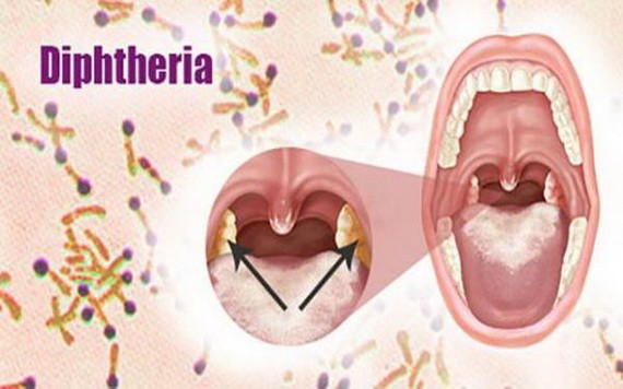 白喉桿菌只感染了咽喉部，形成很小一片白膜，但它會釋放一種叫做白喉桿菌外毒素。這種毒素可厲害了，它可使細胞水腫、壞死，心臟停跳，神經癱瘓。（示意圖源：互聯網）