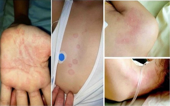 患有多系統炎症綜合徵的孩子，其皮膚上出現皮疹。（圖源：醫學網站）