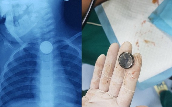 左圖：X光片上顯示，食道內有一棵類似紐扣型電池的異物卡住；右圖：經軟管內窺鏡手術從女童食道取出一棵紐扣型電池。（圖源：院方提供）