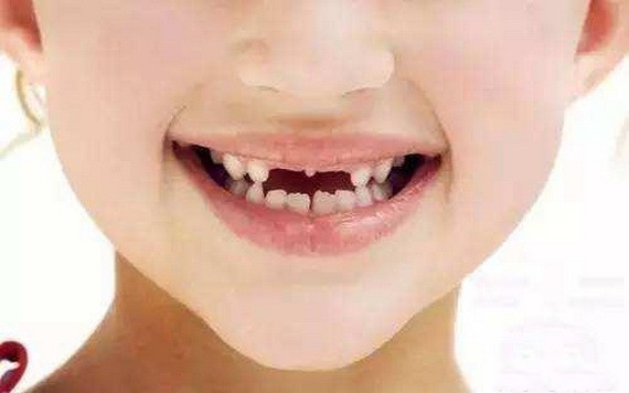 兒童牙頜畸形要早期矯治嗎？