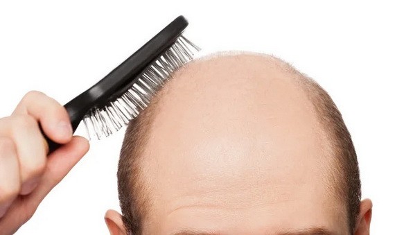 脫髮八問：生薑洗髮水能減少脫髮嗎？