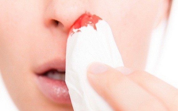鼻子反復出血一定預示著白血病嗎？