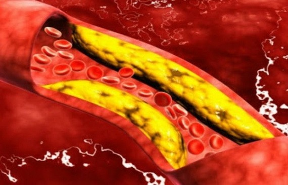 血管裡斑塊能溶解或被吸出來？