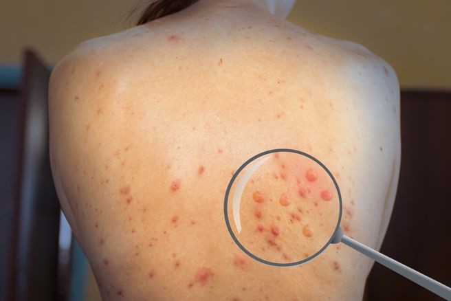 英國一項研究發現，猴痘的傳播可以在任何症狀出現之前的4天內發生。（示意圖：Shutterstock）