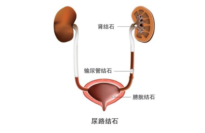 尿路结石患者日常注意事项