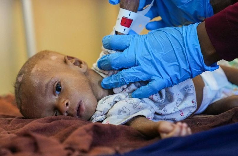 8个月大的易卜拉欣营养不良，在索马里首都摩加迪沙的一家医院里，医生正在测量他的臂围。（图：联合国）