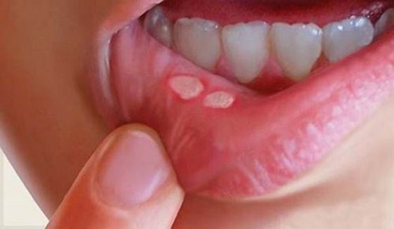轻忽口腔溃疡 细菌入侵心脏破洞