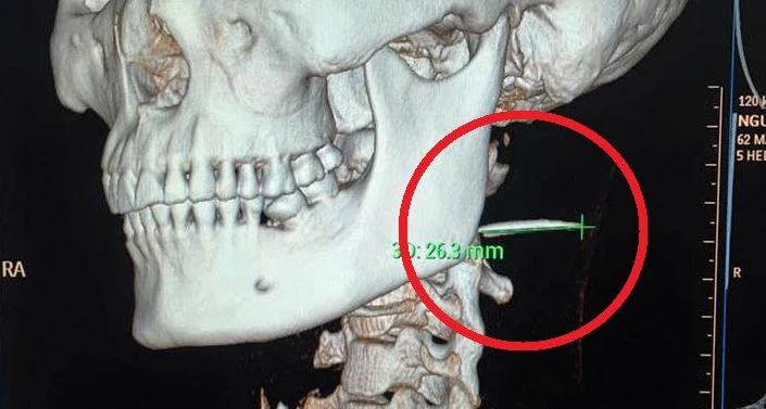 Vị trí xương cá nằm trong cổ họng bệnh nhân suốt 3 tháng. Ảnh chụp CT cổ bệnh nhân