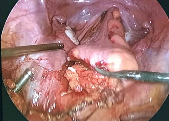 Surgeons use transverse colon to construct vagina for three women (Photo: SGGP)