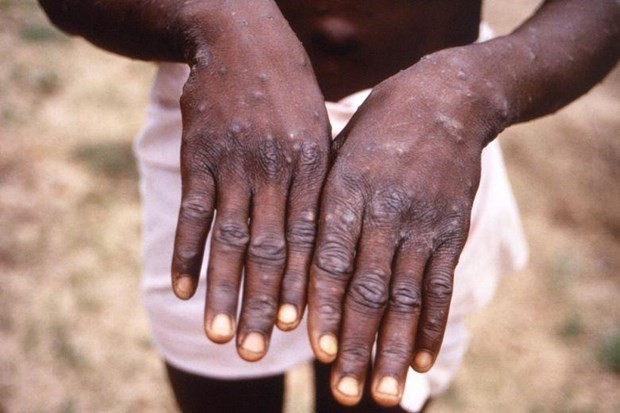 Hands of a patient with monkeypox in 1997 (Source: straitstimes.com)