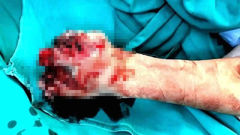 Bàn tay trái của bệnh nhân bị tổn thương nghiêm trọng do điện thoại phát nổ