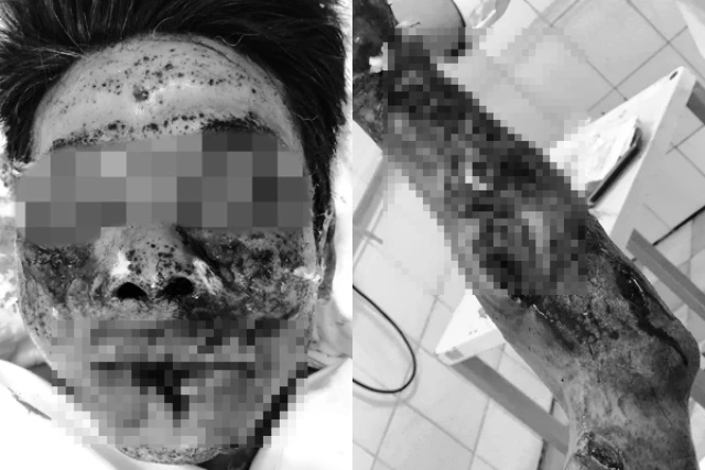 Bệnh nhân K. bị tổn thương nghiêm trọng vùng mặt và tay sau khi đốt pháo tự chế