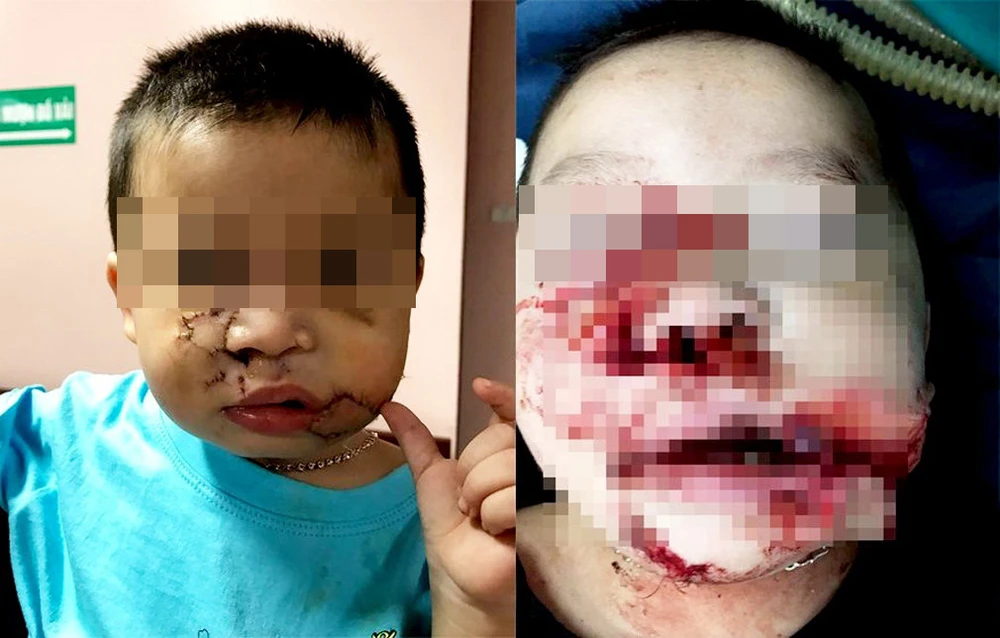 Một cháu bé được phẫu thuật tạo hình vùng mặt sau khi bị chó nuôi cắn gây thương tích nặng