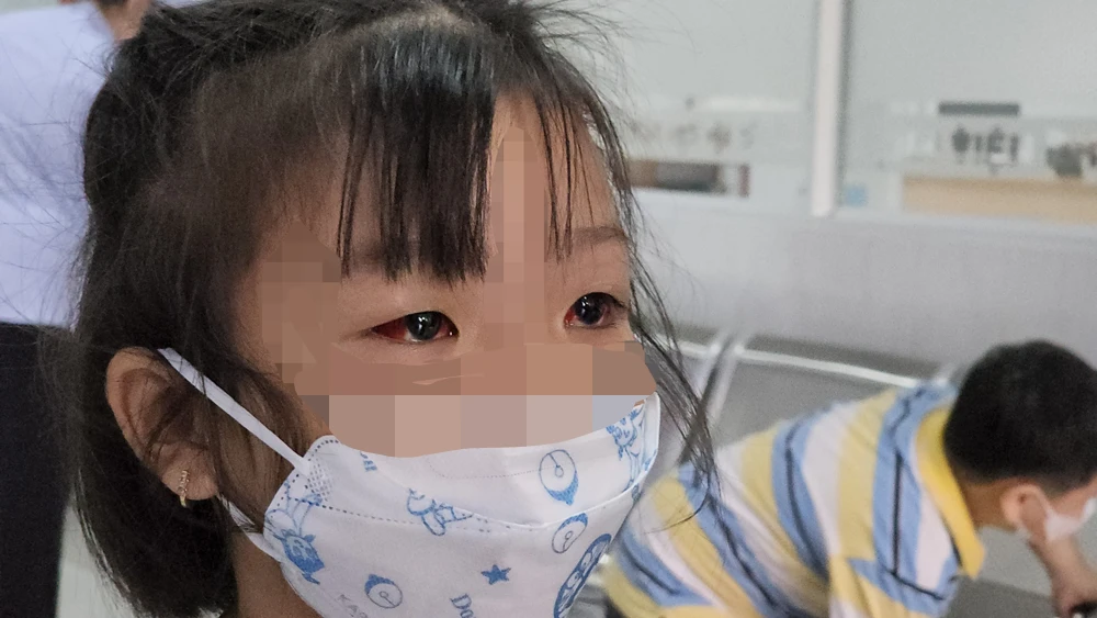 Một bệnh nhi bị đau mắt đỏ đang được điều trị tại Bệnh viện Nhi đồng 2