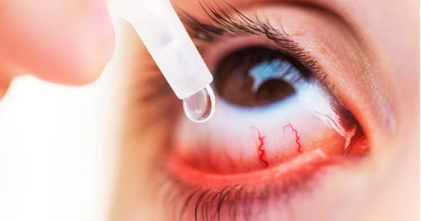 Cảnh báo tình trạng dùng kháng sinh chữa đau mắt đỏ