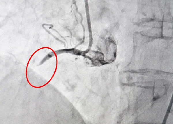 Ảnh DSA - động mạch vành phải của bệnh nhân bị tắc nghẽn hoàn toàn trước khi can thiệp
