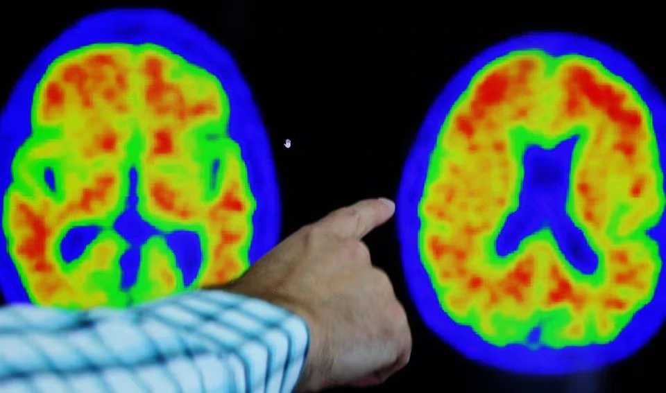 Nghiên cứu trở lại vaccine ngừa bệnh Alzheimer