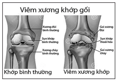 Xóa bỏ nỗi lo bệnh thoái hóa xương khớp - không lãng phí tiền và thời gian