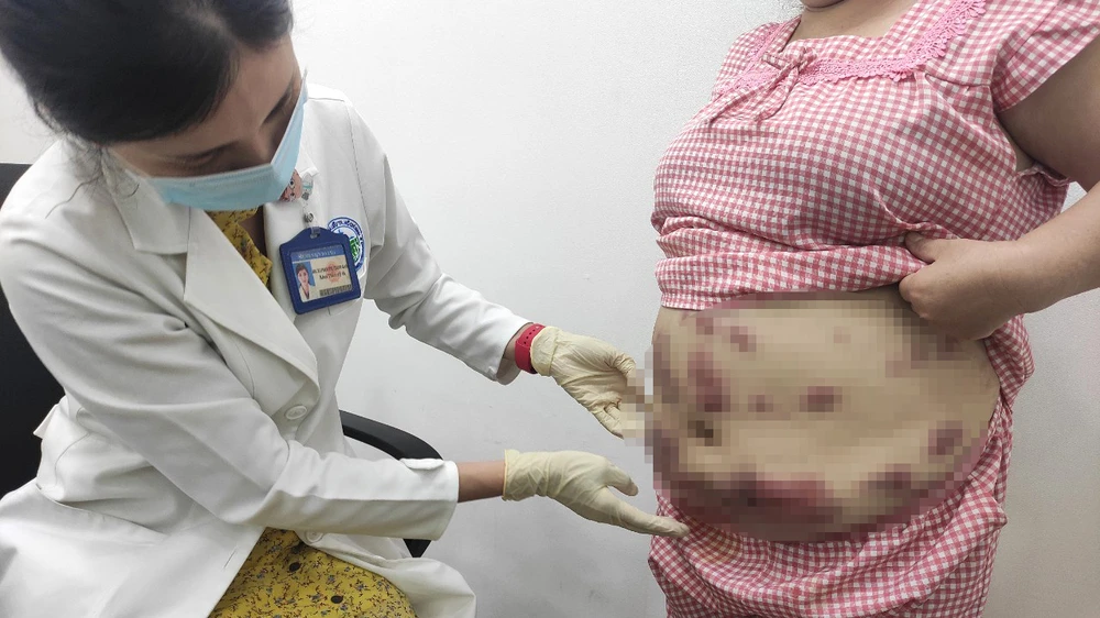 Bác sĩ Bệnh viện Da liễu TPHCM thăm khám cho bệnh nhân bị biến chứng do tiêm chất tan mỡ