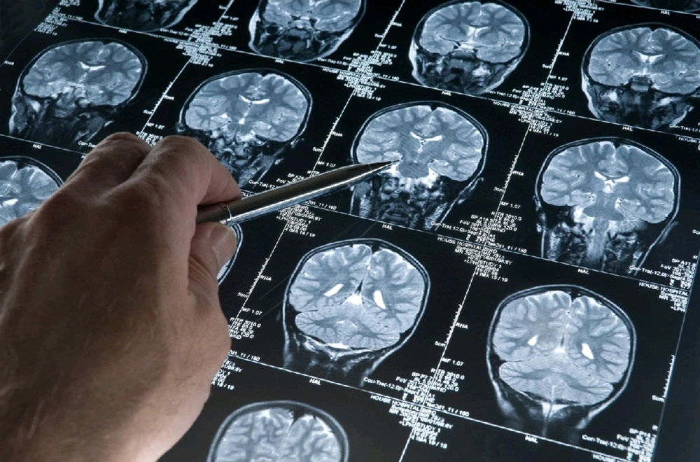Điều trị bệnh Parkinson bằng sóng siêu âm có nhiều triển vọng