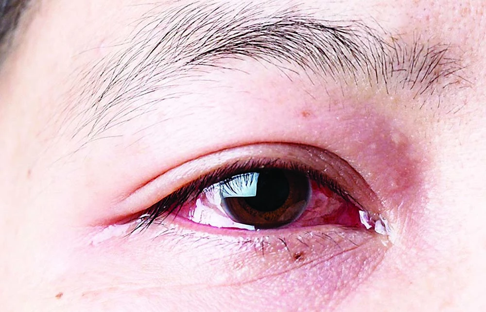 Biểu hiện của bệnh là đỏ mắt, ngứa và sưng mắt