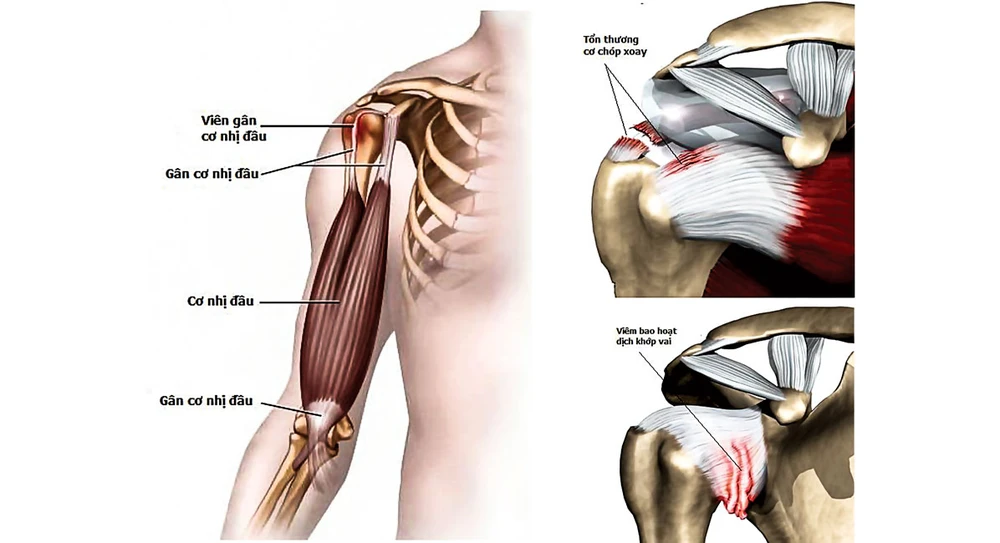 Các tổn thương thường thấy ở khớp vai: Viêm gân cơ nhị đầu; viêm hoặc rách cơ chóp xoay; viêm bao hoạt dịch khớp vai (thường co thắt gây cứng khớp vai).