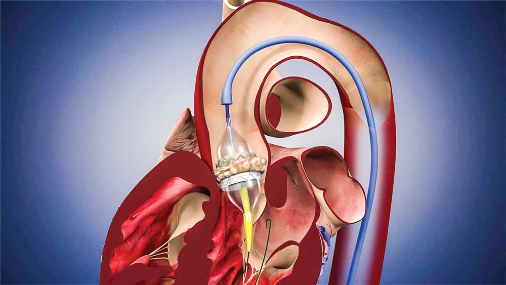 Kỹ thuật thay van tim động mạch chủ qua ống thông