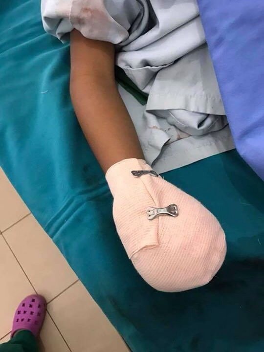 一名男童的手因一節在路邊拾起的電芯爆炸而受傷。（圖片來源：互聯網）
