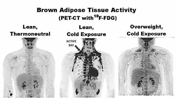 PET/CT掃描，寒冷條件下瘦的人，其肩胛骨等部位褐色脂肪更多。