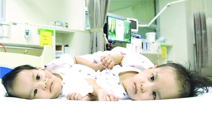 不丹下腹相連雙胞胎手術成功分離