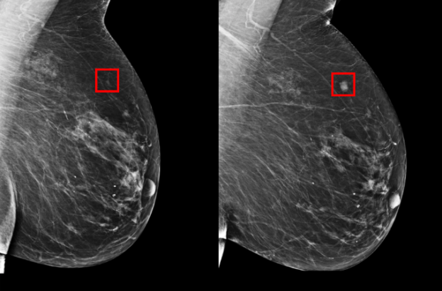 麻省理工（MIT）電腦科學與 AI 實驗室（MIT CSAIL）開發出一款風險預測 AI 模型，可以識別乳房組織的細微變化，並確定在未來５年發展為乳腺癌的可能性。