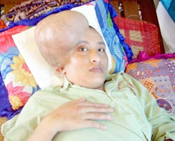 Anh Hà với khối u gần 5kg trên đầu