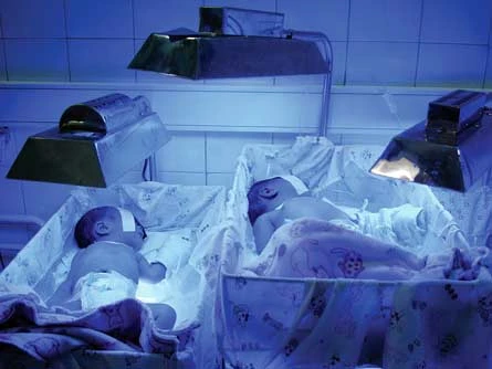 Bệnh vàng da trẻ sơ sinh - Chữa bằng công nghệ chiếu đèn, giá rẻ