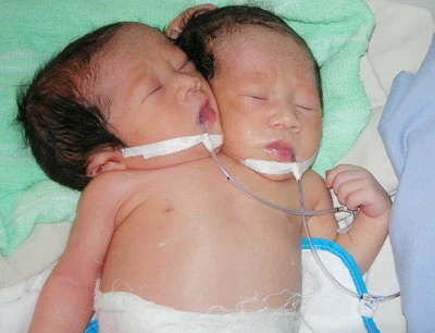 Sóc Trăng: Một bé gái sơ sinh có hai đầu