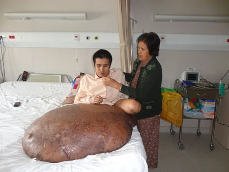 Sáng nay, phẫu thuật bệnh nhân “chân voi” 90kg