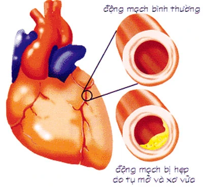 Đau tim (đau thắt ngực) – Dấu hiệu nguy hiểm!