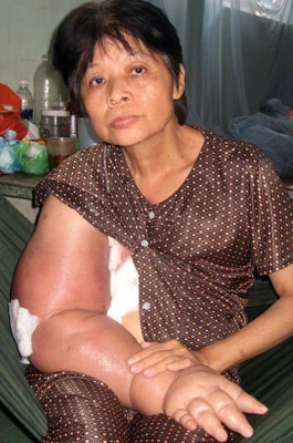 Mẹ tai biến, con ung thư