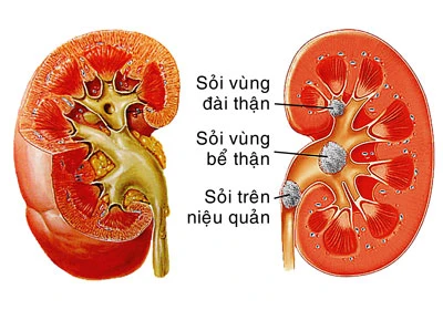 Sỏi thận - Ngăn ngừa tái phát trong điều trị