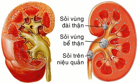 Sỏi thận - Ngăn ngừa tái phát trong điều trị